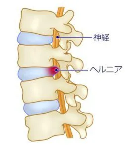 椎間板ヘルニア側面から見たイラスト