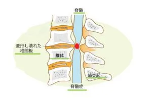 頚椎症説明図