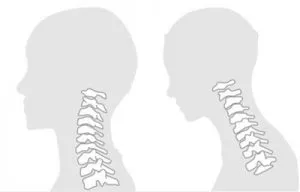 正常な首とストレートネック比較