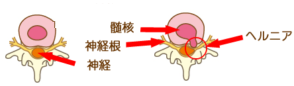 椎間板ヘルニア説明図