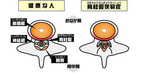 健康な人と脊柱菅狭窄症の人の脊柱管の状況