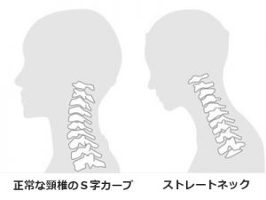 正常な頚椎のカーブとストレートネックの比較